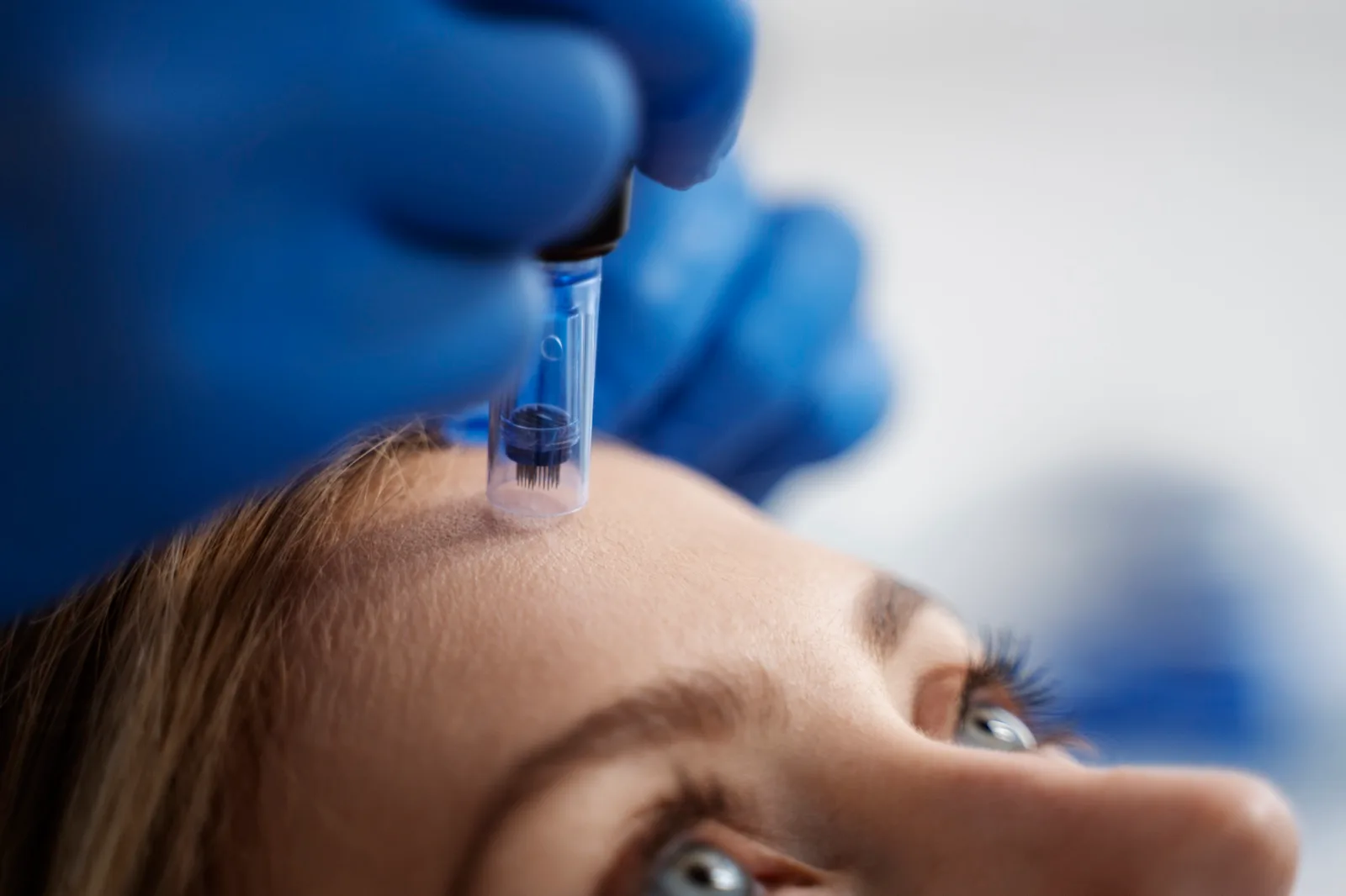 Microneedling an der Stirn